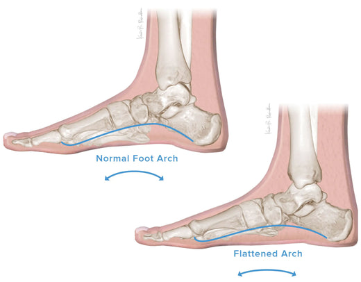 Pes Planus / Flatfoot