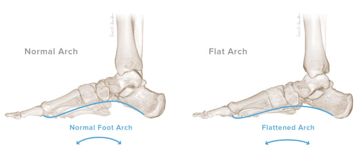 Pes Planus / Flatfoot