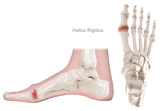 Hallux Limitus / Rigidus