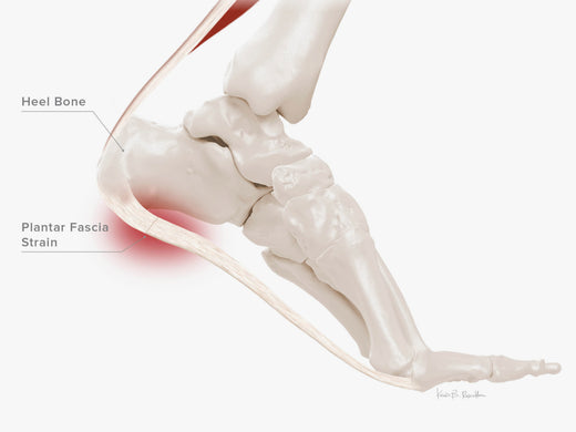 Plantar Fasciitis