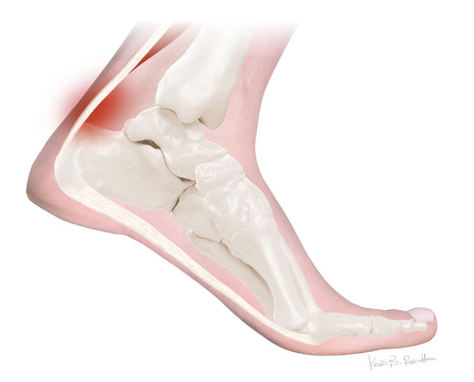 Achilles Tendinopathy