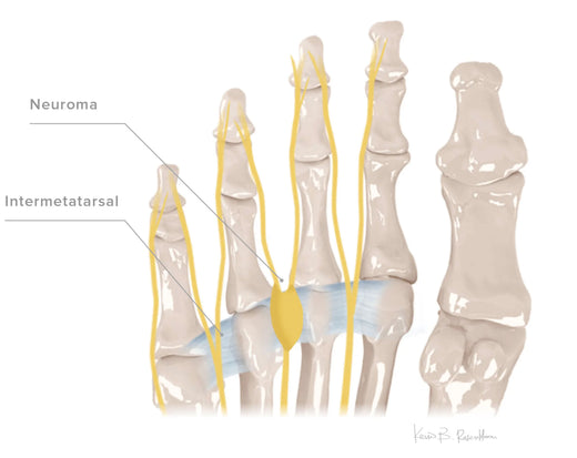 Morton's Neuroma