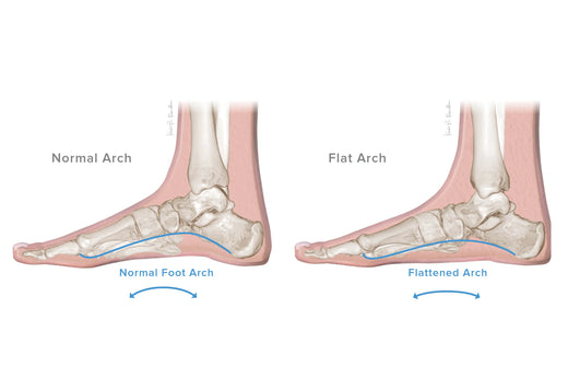 PTTD / Adult Flatfoot